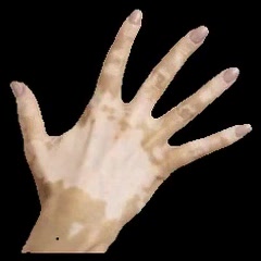 Input image: in-the-wild hand with vitiligo