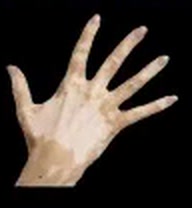 Input image: in-the-wild hand with vitiligo